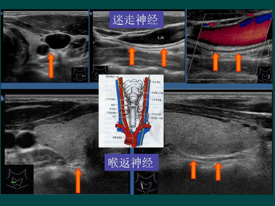 甲状腺癌的超声检查.ppt_第3页