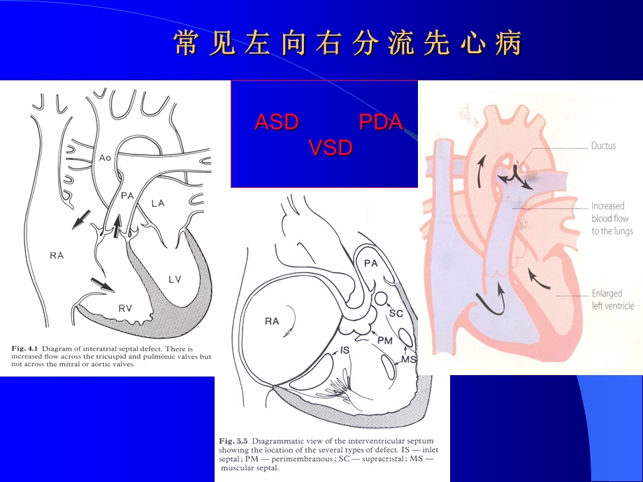 先天性心脏病血流动力学.ppt_第3页