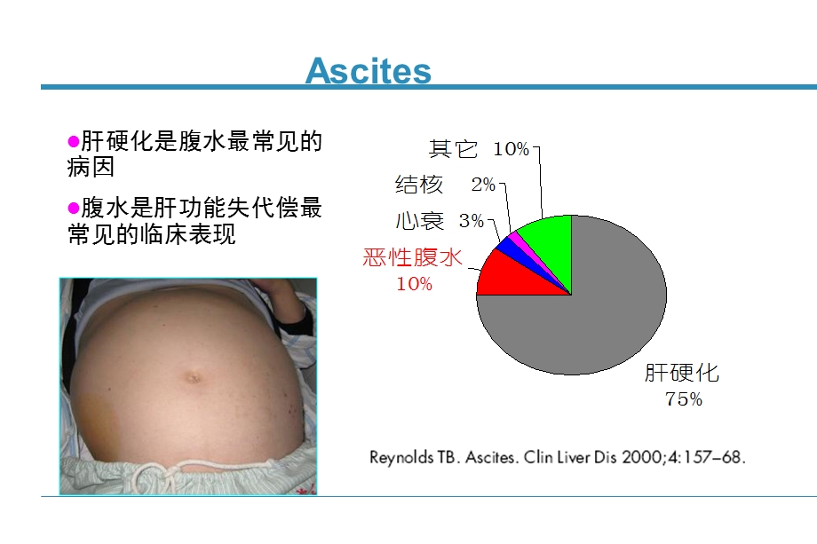 肝硬化腹水的规范性诊治.ppt_第2页