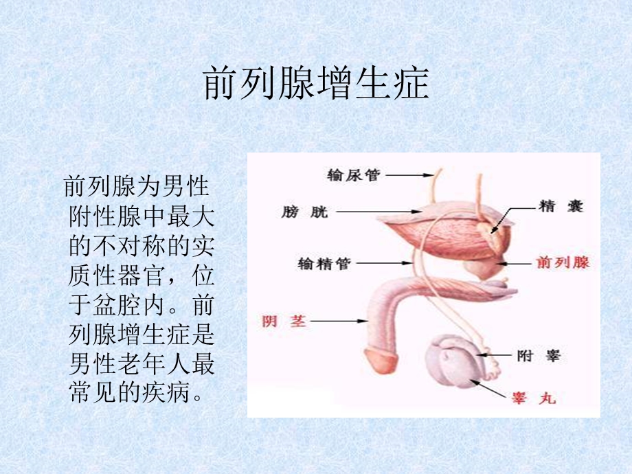 前列腺增生症PPT课件.ppt_第2页