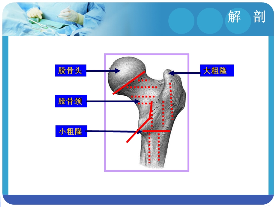 股骨颈骨折护理-常规.ppt_第3页