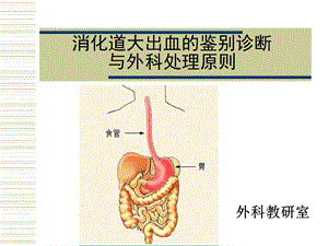 消化道大出血的鉴别诊断与外科处理原则.ppt