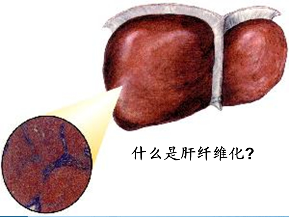 肝纤维化的危害及中医防治.ppt_第2页