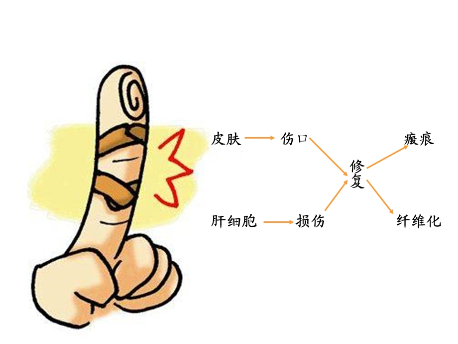 肝纤维化的危害及中医防治.ppt_第3页