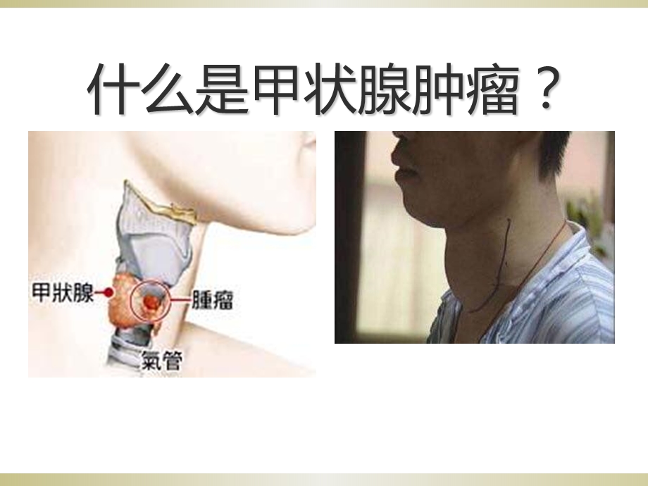 甲状腺疾病知识宣教.ppt_第2页