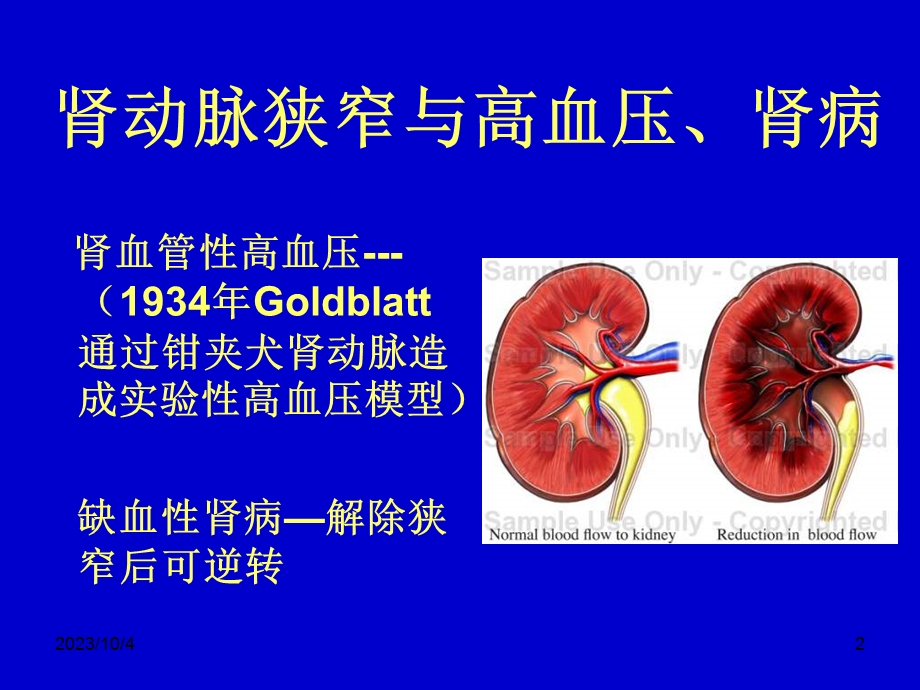 肾血管性高血压的诊断与治疗秦永文.ppt_第2页