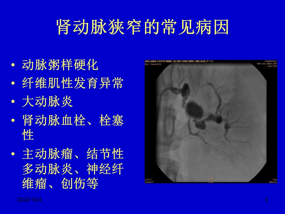 肾血管性高血压的诊断与治疗秦永文.ppt_第3页