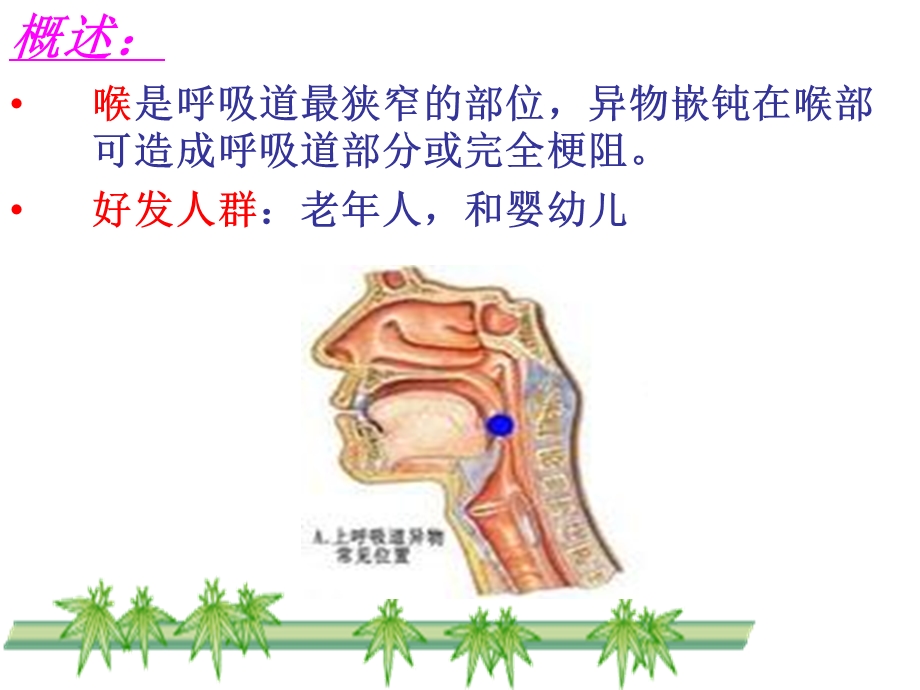 气道异物梗阻急救技术.ppt_第2页