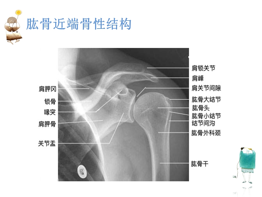 肱骨近端骨折护理查房.ppt_第3页