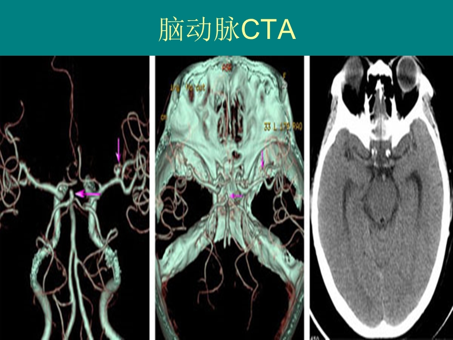 多排螺旋CT的临床应用PPT课件.ppt_第3页