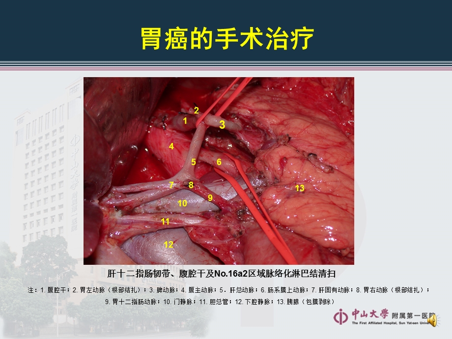 胃癌根治术后特殊并发症及防治.ppt_第3页