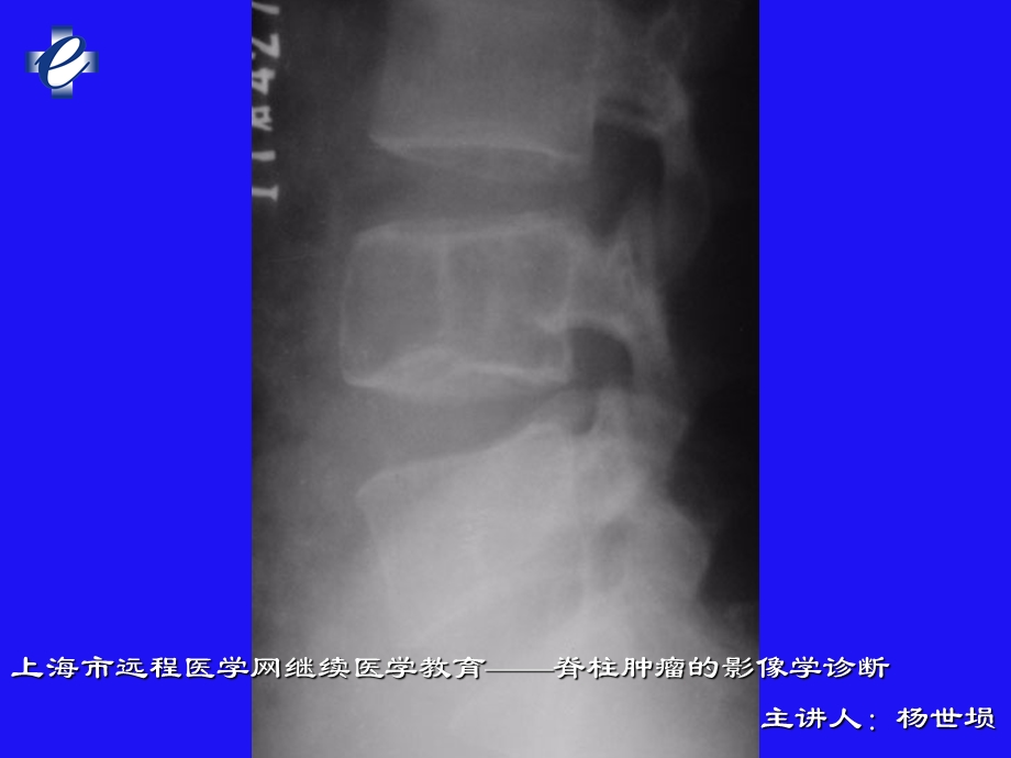 脊柱肿瘤的影像学诊断2.ppt_第2页