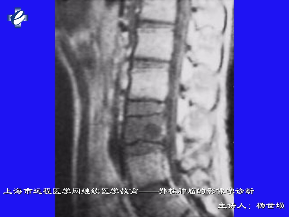 脊柱肿瘤的影像学诊断2.ppt_第3页