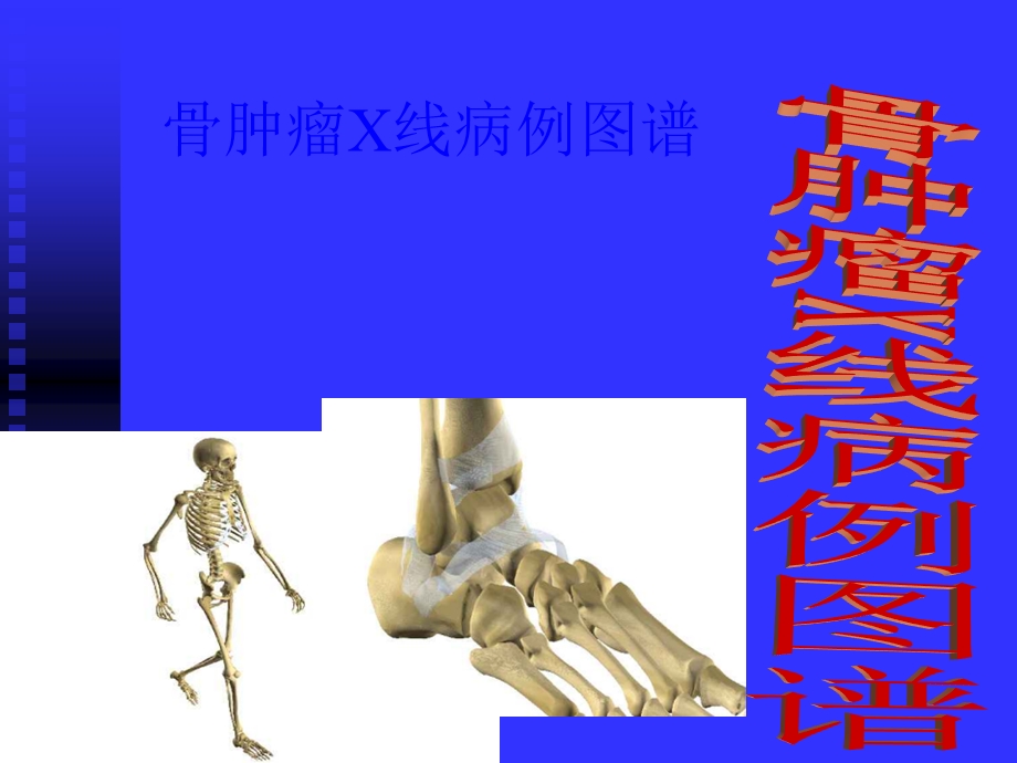 骨肿瘤X线病历图谱骨瘤【课件PPT】.ppt_第1页