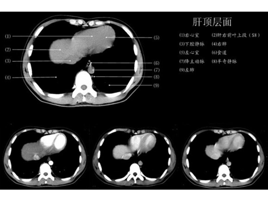 上腹部CT各个层面 PPT素材.ppt_第2页