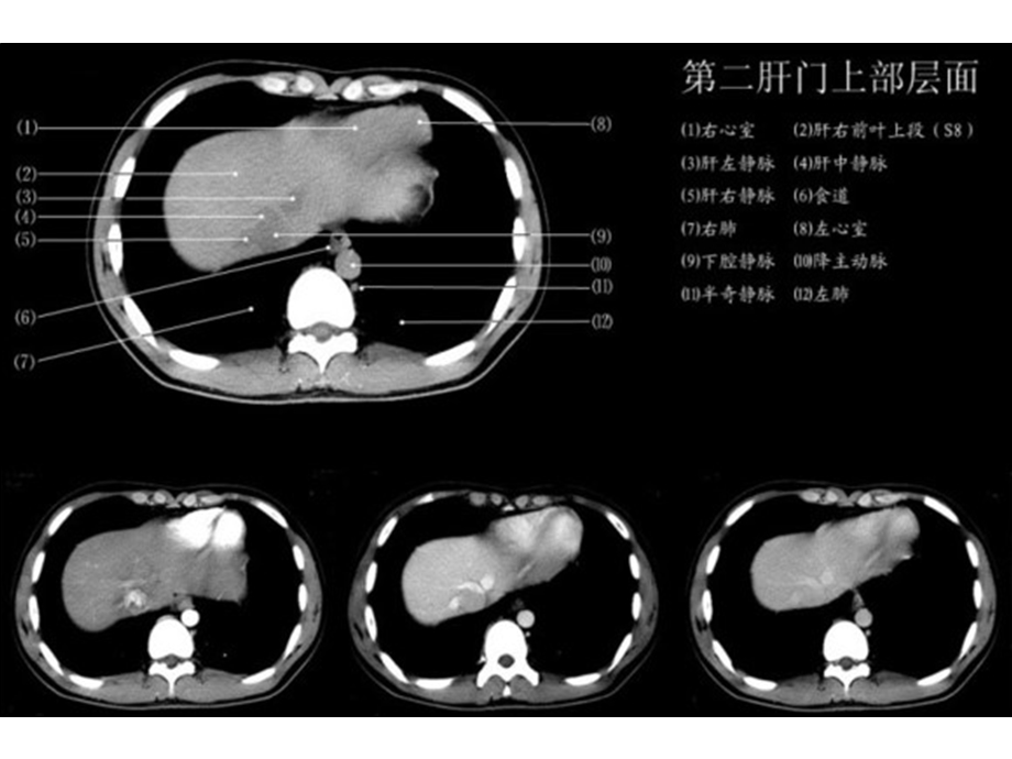 上腹部CT各个层面 PPT素材.ppt_第3页
