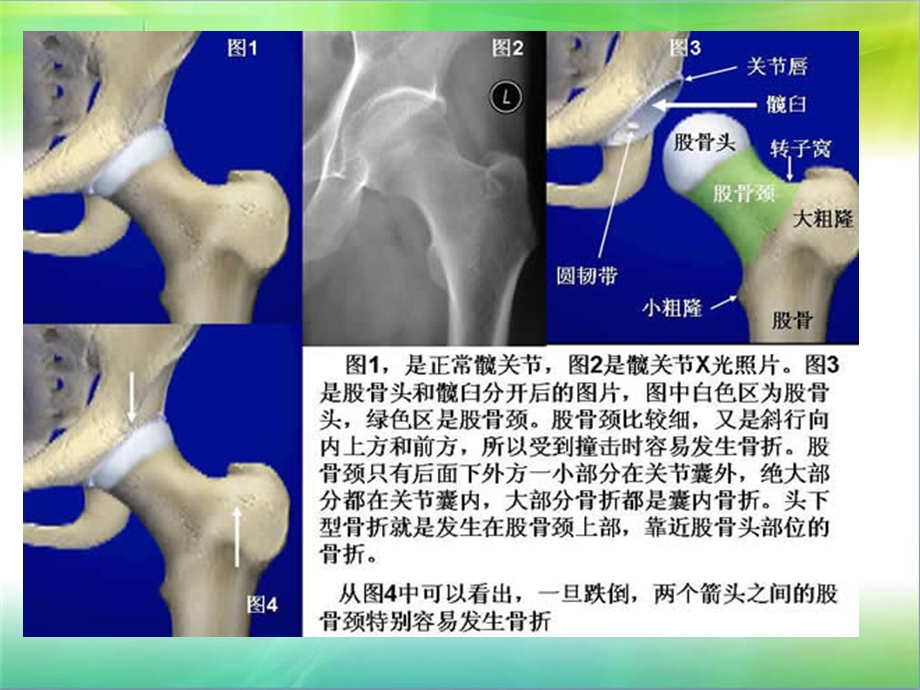 髋关节置换术的护理.ppt_第3页