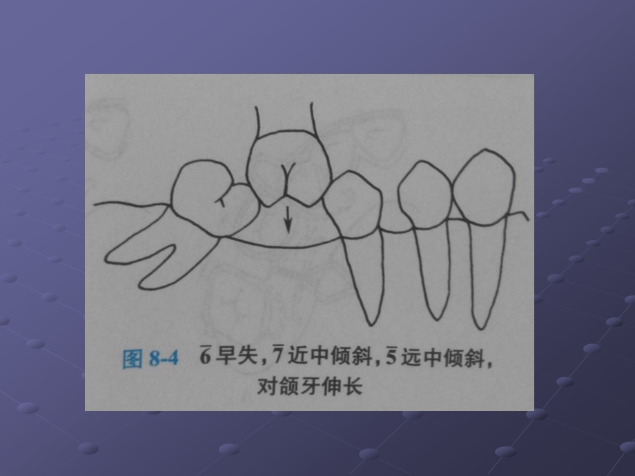 青少年口腔正畸矫治.ppt_第3页