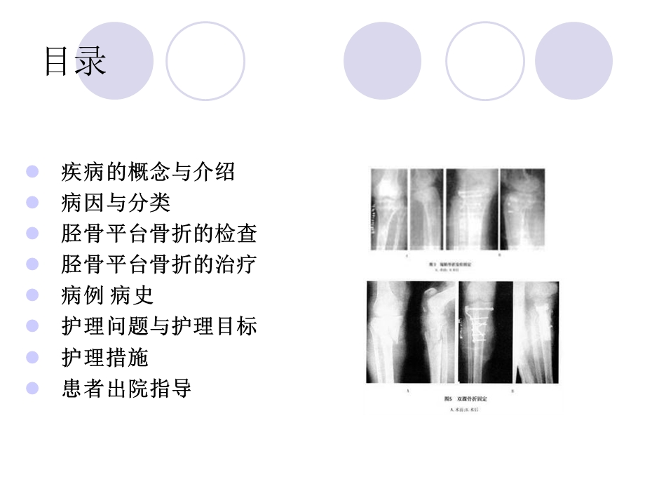 胫骨平台骨折的护理查房ppt课件.ppt_第2页