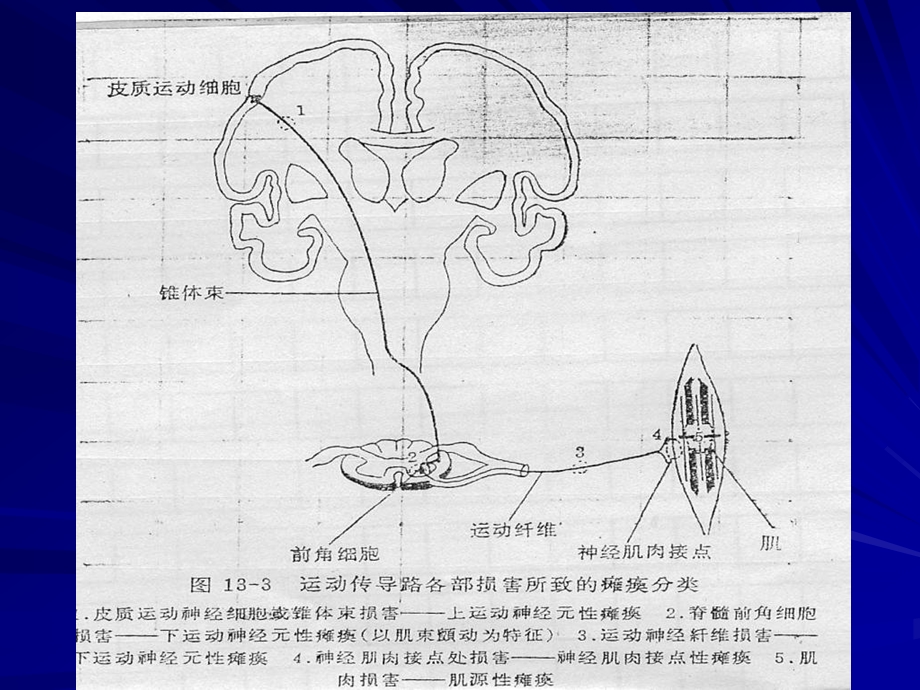 脊髓灰质炎的诊断与鉴别诊断.ppt_第3页