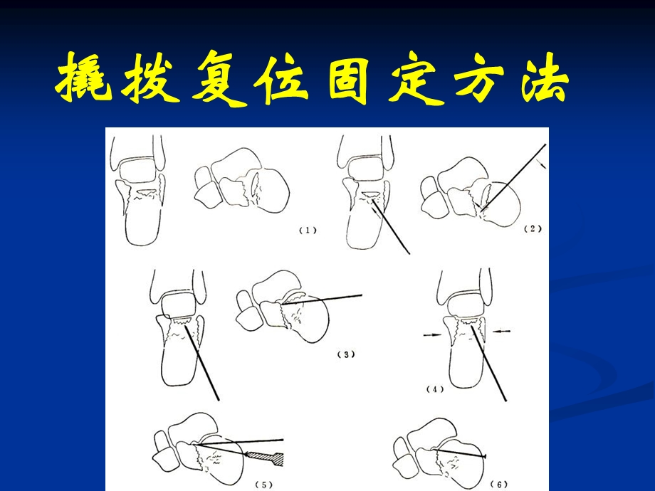 跟骨骨折治疗的新理念.ppt_第3页