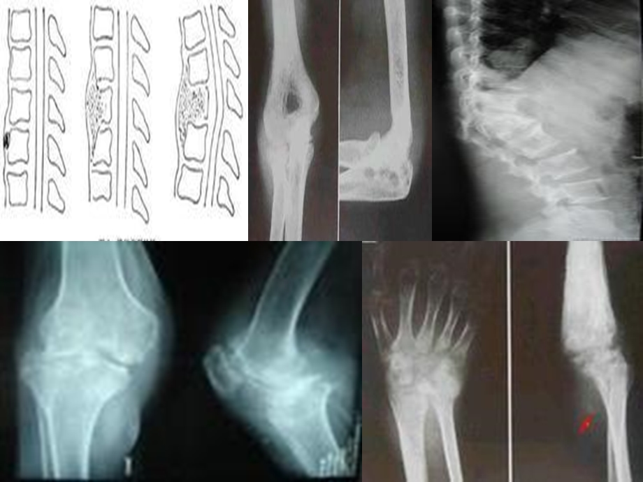 骨关节结核病人的护理PPT课件.ppt_第2页