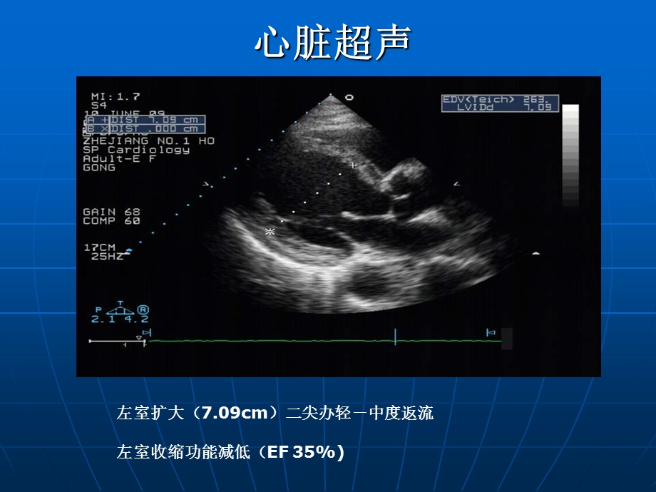 起搏器介导的心动过速pmt一例.ppt_第3页