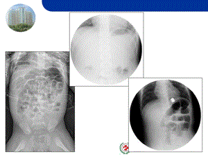 肠套叠x线诊断与复位 ppt课件.ppt