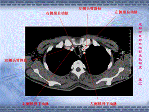 肺部CT-肺部纵隔窗.ppt