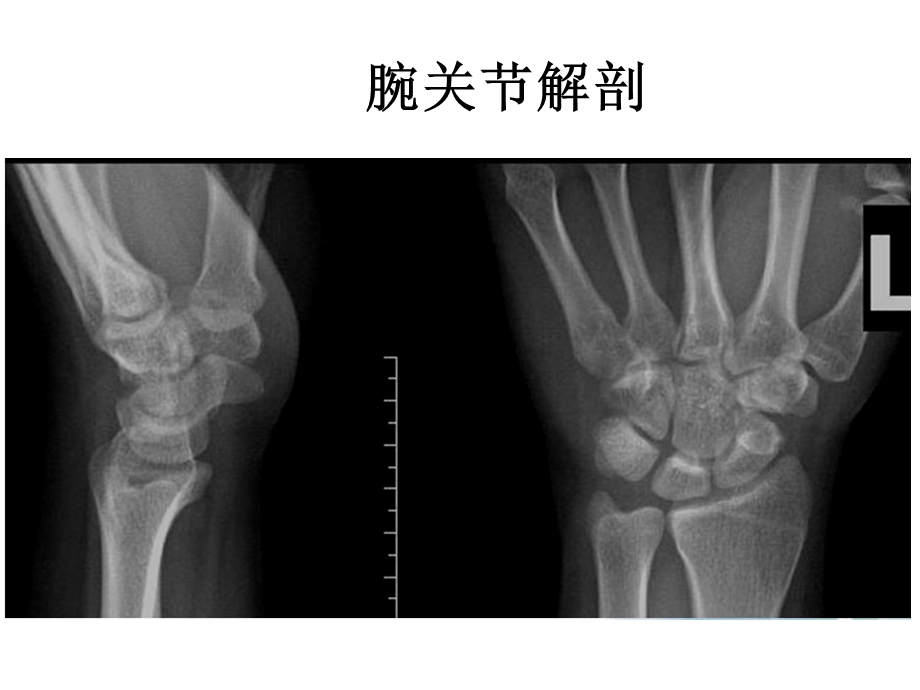 腕关节X线解剖及常见骨折诊断.ppt_第3页