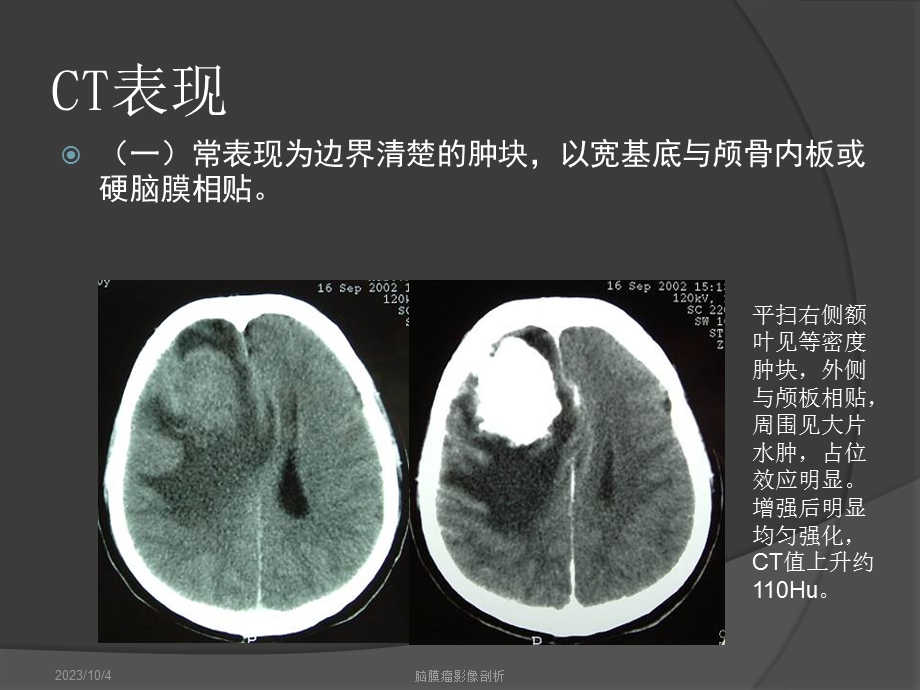 脑膜瘤影像学表现.ppt_第3页