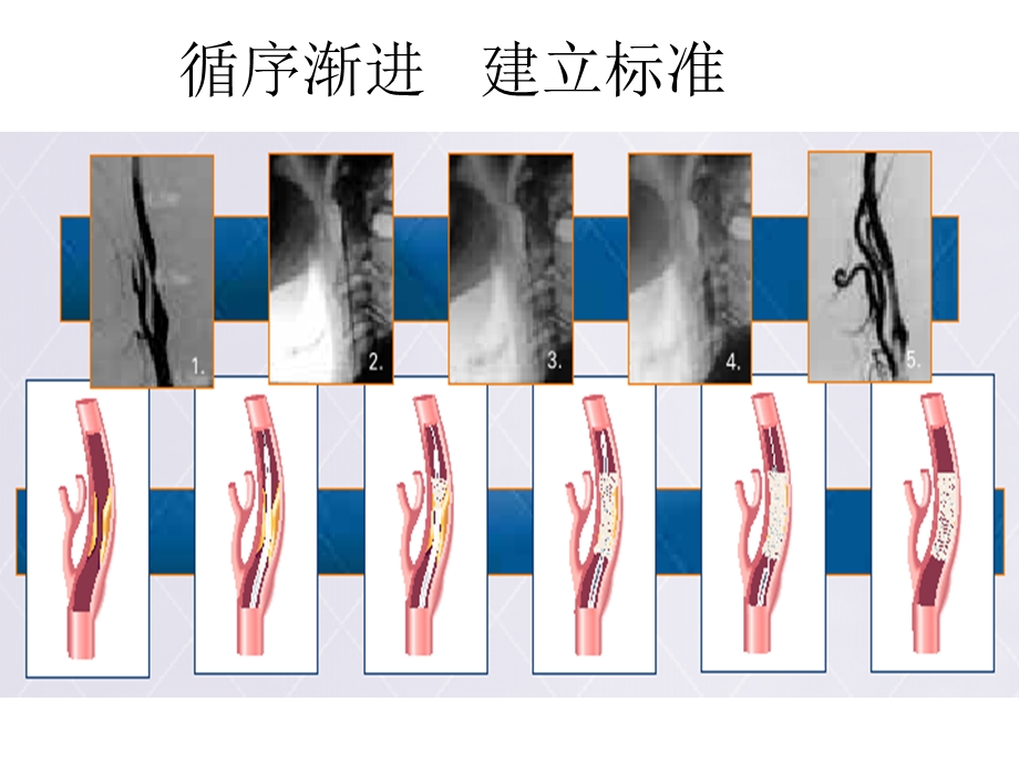 颈动脉支架手术步.ppt_第2页