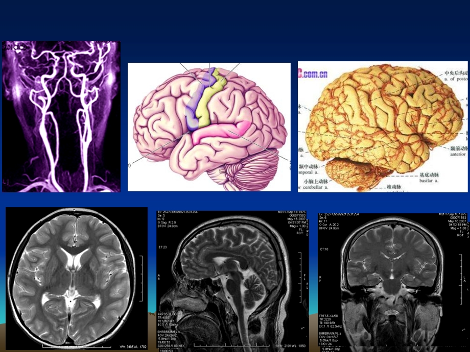 脑血管断层影像解剖.ppt_第2页