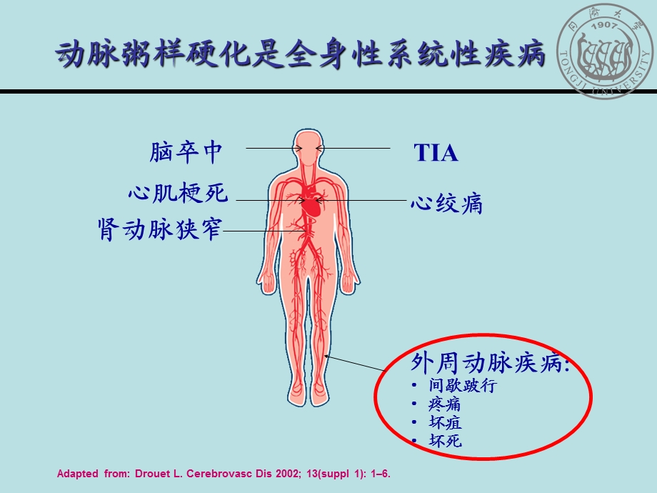 从循证医学证据看关注外周血管疾病的重要性.ppt_第3页