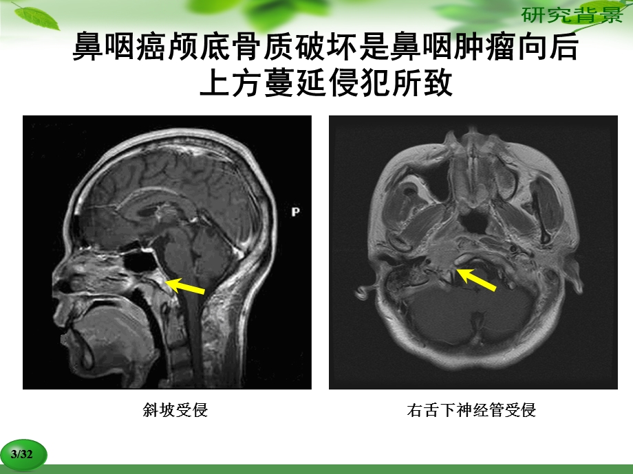 鼻咽癌颅底骨质破坏.ppt_第3页