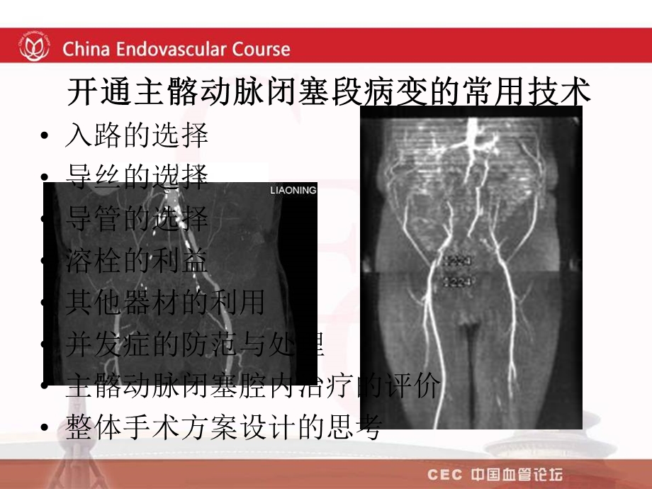 开通主髂动脉闭塞段病变的常用技术吴丹明.ppt_第2页