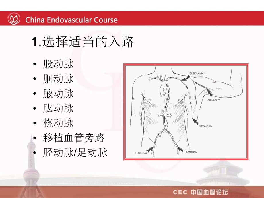 开通主髂动脉闭塞段病变的常用技术吴丹明.ppt_第3页