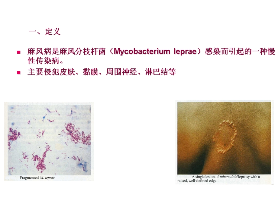 麻风病临床诊断和鉴别.ppt_第3页