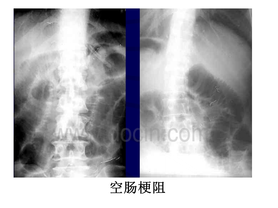 急腹症肠梗阻现象 ppt课件.ppt_第2页