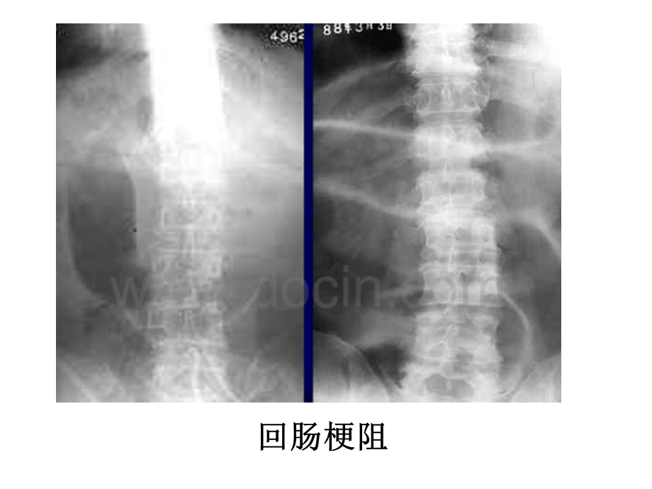 急腹症肠梗阻现象 ppt课件.ppt_第3页