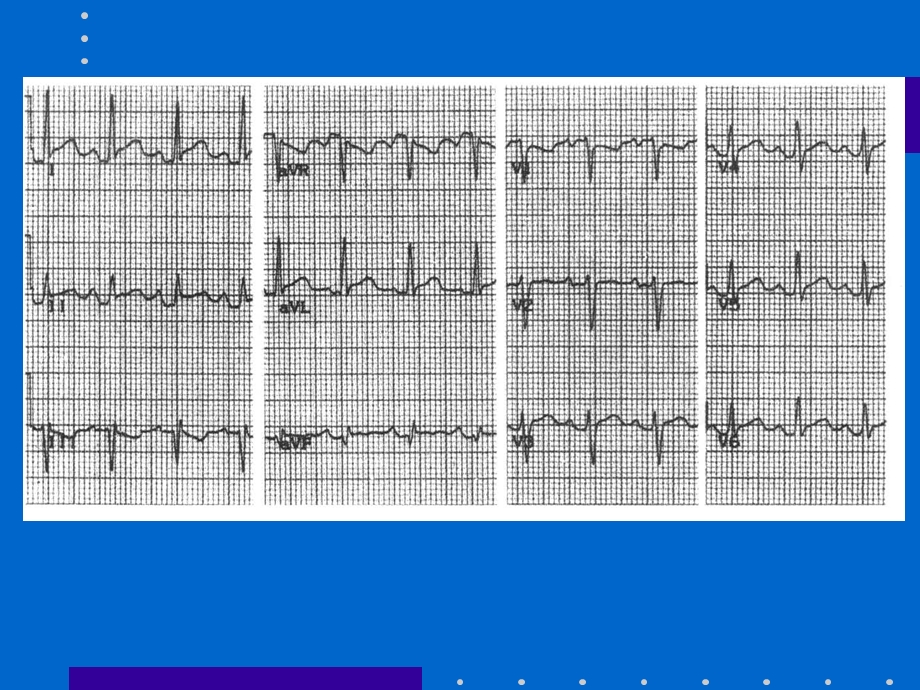 ECG心电图的解读.ppt_第2页