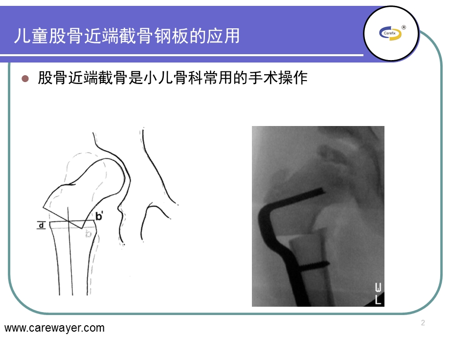 lcppediatricplate的临床应用.ppt_第2页