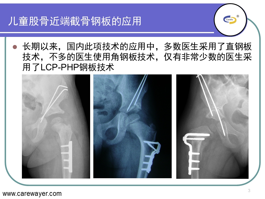 lcppediatricplate的临床应用.ppt_第3页