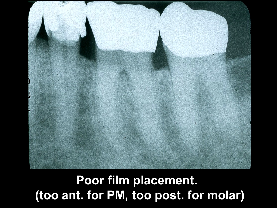 intra-oraltech-errors学会看拍牙.ppt_第3页