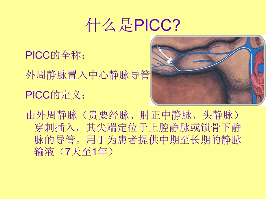 ICC置管术相关知识.ppt_第2页