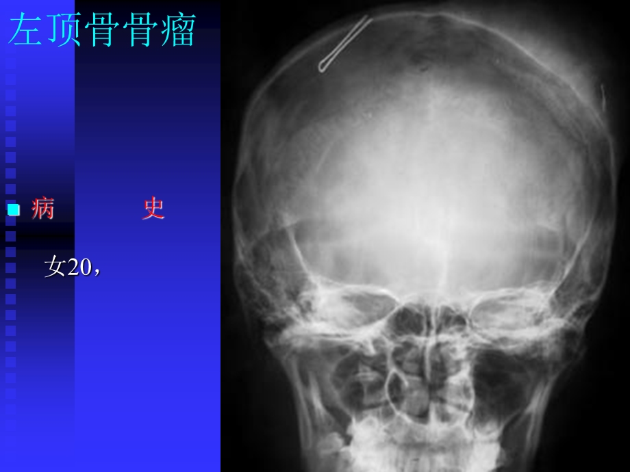 x线学习资料骨肿瘤x线病历图谱.ppt_第3页