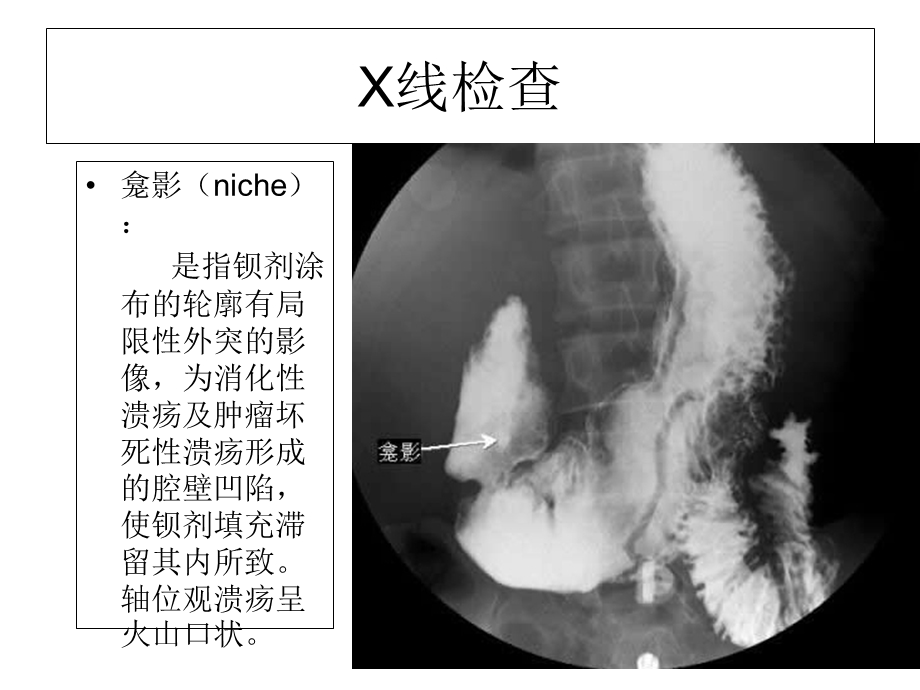 X线胃镜隐血试验结果的临床意义.ppt_第2页