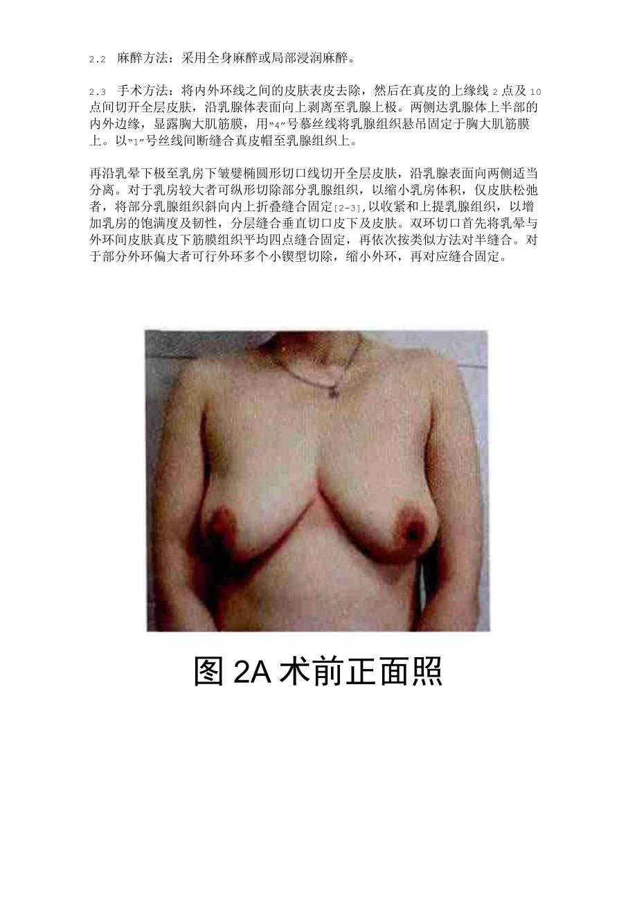 医美整形乳房下垂矫治术培训课件.docx_第3页