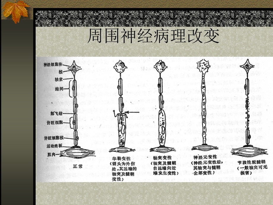 周围神经病图谱文稿.ppt_第3页