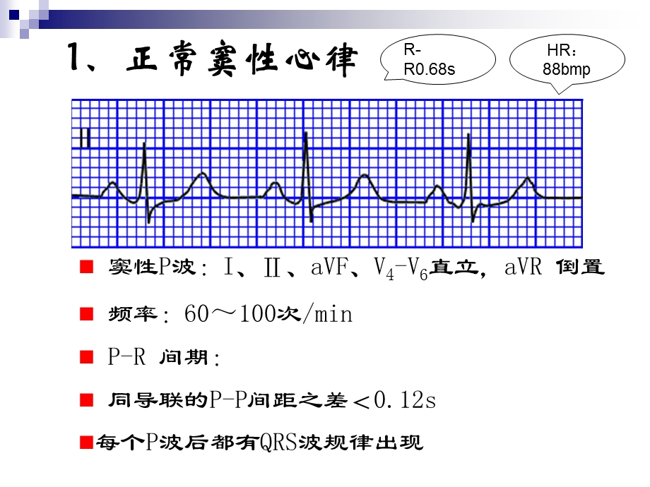 心律失常实验课用.ppt_第3页